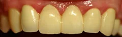 After: a porcelain bridge in place
