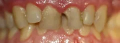 Before: prepared teeth with a missing front tooth