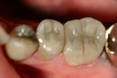 After: molars restored with esthetic resin
