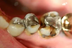 Before: molars with old silver and gold fillings