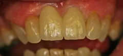 After: upper front teeth restored with ceramic implants