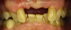 Before: missing upper front teeth