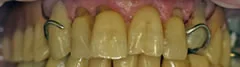 Before: a removable partial with visible metal clasps