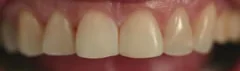 After: front teeth reshaped with esthetic resin
