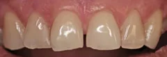 Before: front teeth with a gap and uneven edges