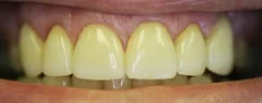 After: permanent ceramic veneers