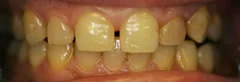 Before: discolored front teeth with a gap