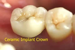 A ceramic implant crown