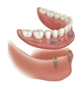 Illustration of a lower denture secured by dental implants