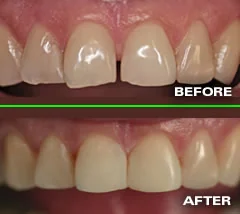 Before and after: chipped, gapped front teeth restored with esthetic resin